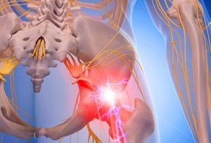 Sciatica Pain Treatment