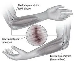 pathakwavecurecenter.in  Tennis Elbow Treatment November 1, 2019 Neuro physician gallery-Images of Pathak Wave Cure Center – 