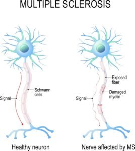 multiple sclerosis Treatment in Noida