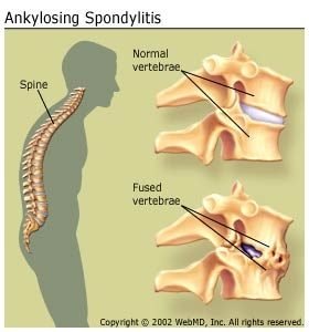 ankylosis spondylitis