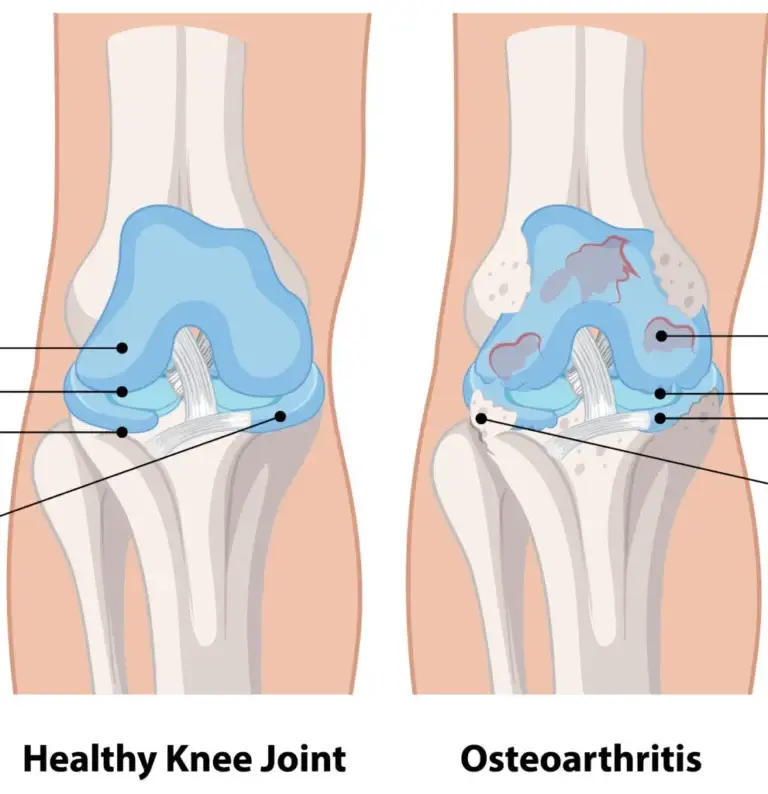 pathakwavecurecenter.in  Knee Pain Treatment May 20, 2021 Top knee pain treatment-Knee Pain healing-for Knee Effusions – 
