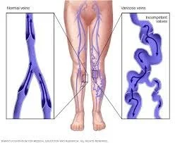 pathakwavecurecenter.in  Varicose Veins December 13, 2019 Best Doctor of Varicose Veins Treatment-Varicose veins issue – 